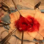 Cystotomie